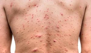 El riesgo de contagio de la viruela del mono es muy bajo