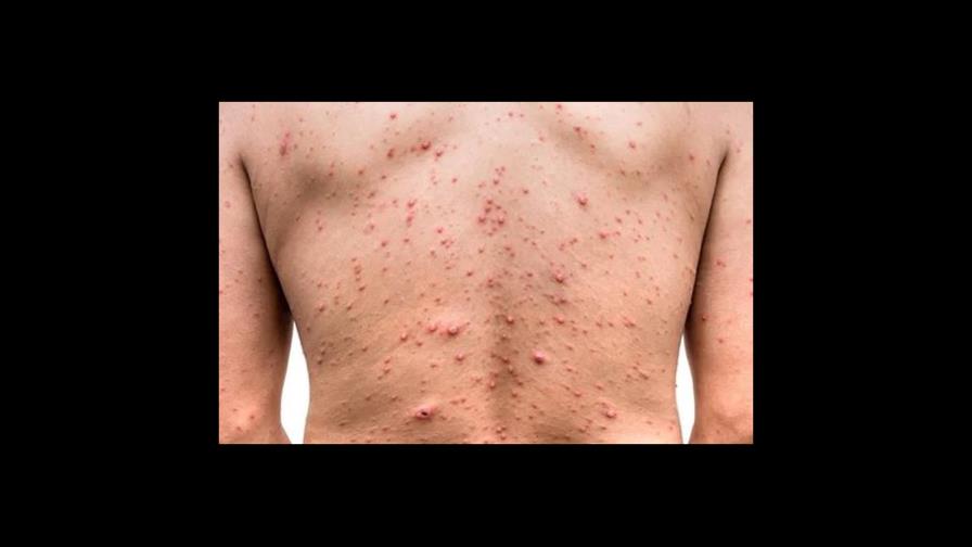 El riesgo de contagio de la viruela del mono es muy bajo El riesgo de contagio de la viruela del mono es muy bajo
