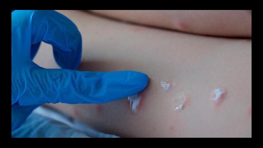 Aeropuertos y zona fronteriza en vigilancia por la viruela del mono Aeropuertos y zona fronteriza en vigilancia por la viruela del mono