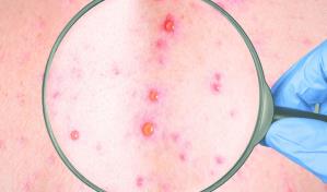 Viruela del mono: diez razones para ser optimistas