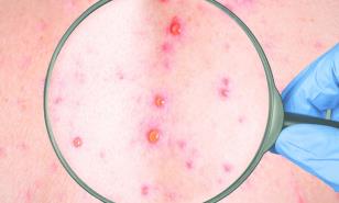 Viruela del mono: diez razones para ser optimistas