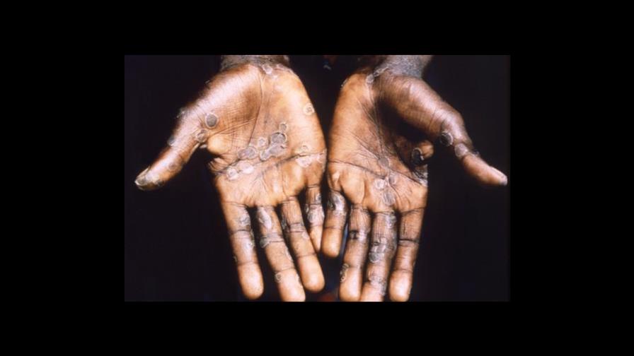 OMS dice que viruela del mono es controlable en Oriente Medio y el riesgo es bajo