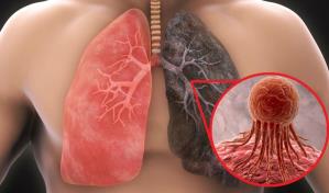 Expertos llaman a disminuir factores de riesgo para evitar c&aacute;ncer