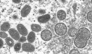Más de 200 casos de viruela símica en el mundo, dice la OMS