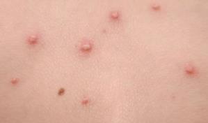 La Comunidad de Madrid detecta el primer caso de viruela de mono en una mujer