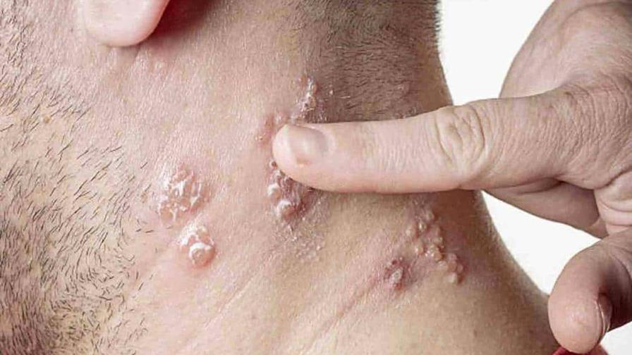 La OMS eleva a 780 los casos globales de viruela del mono