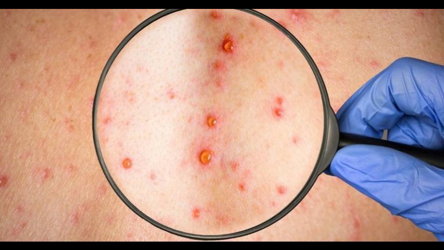 Brasil confirma el primer caso de viruela del mono