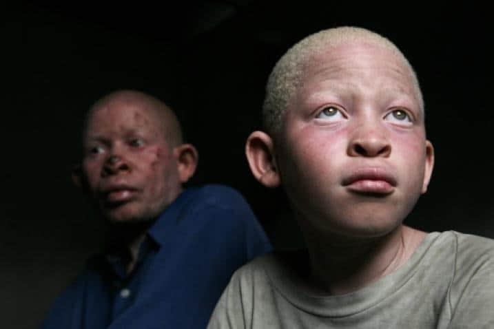 13 de junio, Día Internacional de Sensibilización sobre el Albinismo