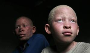 Día Internacional de Sensibilización sobre el Albinismo: la lucha contra el estigma y la discriminación