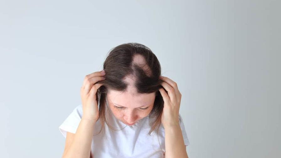EEUU aprueba primera píldora para el tratamiento de la alopecia