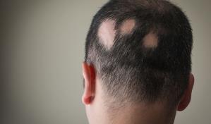 EEUU aprueba primera p&iacute;ldora para el tratamiento de la alopecia