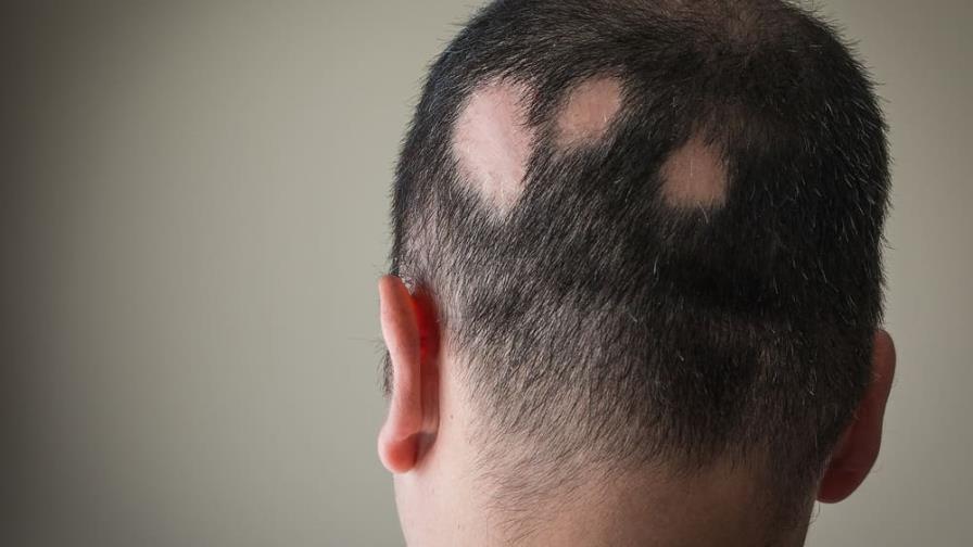 EEUU aprueba primera píldora para el tratamiento de la alopecia EEUU aprueba primera píldora para el tratamiento de la alopecia