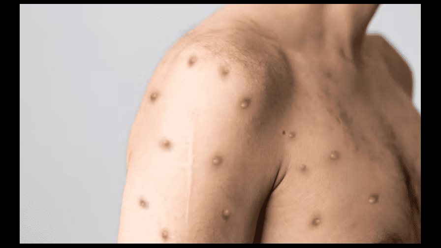 Confirman primer caso de viruela símica en Chile