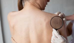 El 57 % de casos de c&aacute;ncer de piel detectados en 2021 fue en mujeres