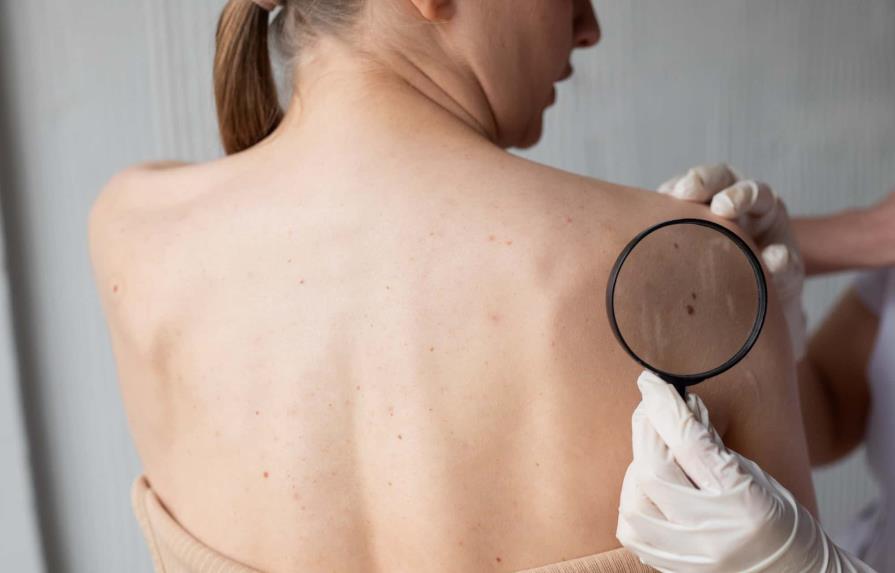 El 57 % de casos de cáncer de piel detectados en 2021 fue en mujeres