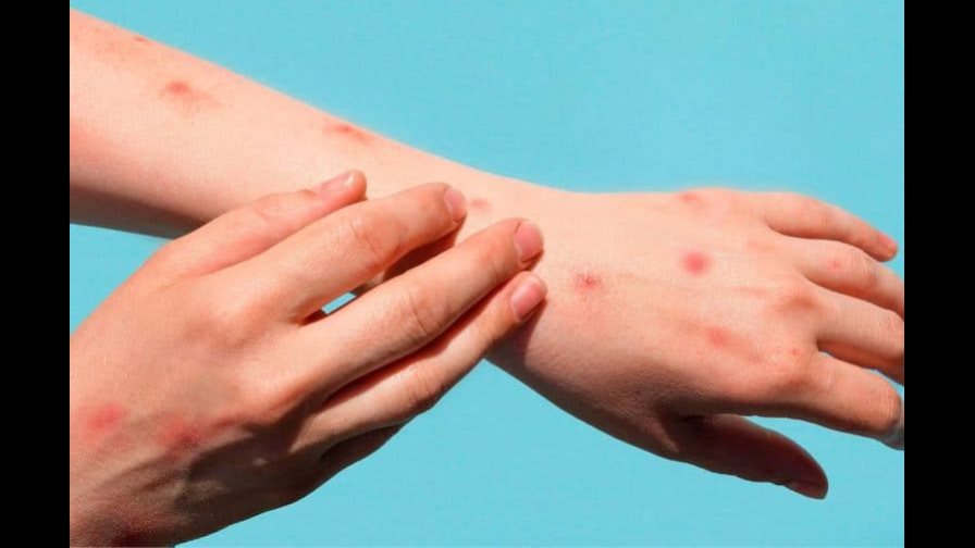 Chile confirma un segundo caso de viruela del mono