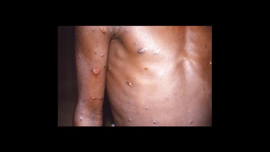 EEUU aumenta capacidad de pruebas de viruela símica