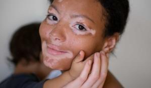 Vitiligo, afección de la piel frecuente de causa desconocida