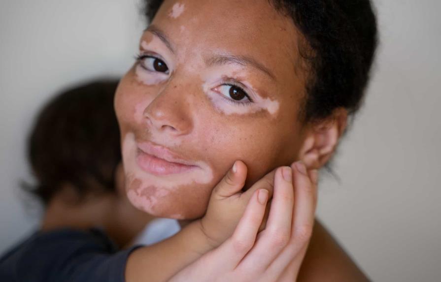 Vitiligo, afección de la piel frecuente de causa desconocida