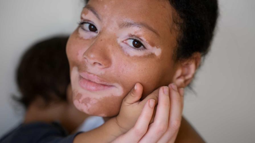 Vitiligo, afección de la piel frecuente de causa desconocida Vitiligo, afección de la piel frecuente de causa desconocida