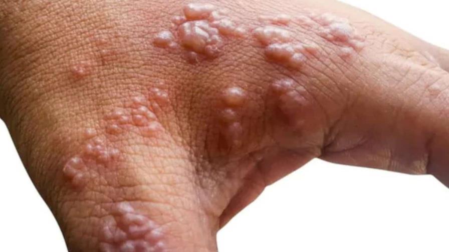 Puerto Rico confirma un segundo caso de viruela del mono Puerto Rico confirma un segundo caso de viruela del mono