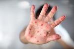 Sostienen que no es raro hallar el virus de la viruela del mono en el semen Sostienen que no es raro hallar el virus de la viruela del mono en el semen