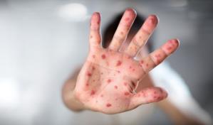 Sostienen que no es raro hallar el virus de la viruela del mono en el semen