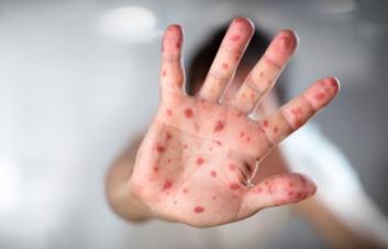 Sostienen que no es raro hallar el virus de la viruela del mono en el semen