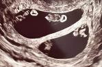 Mujer sorprende a médicos en EEUUU tras salir embarazada de dos pares de gemelos