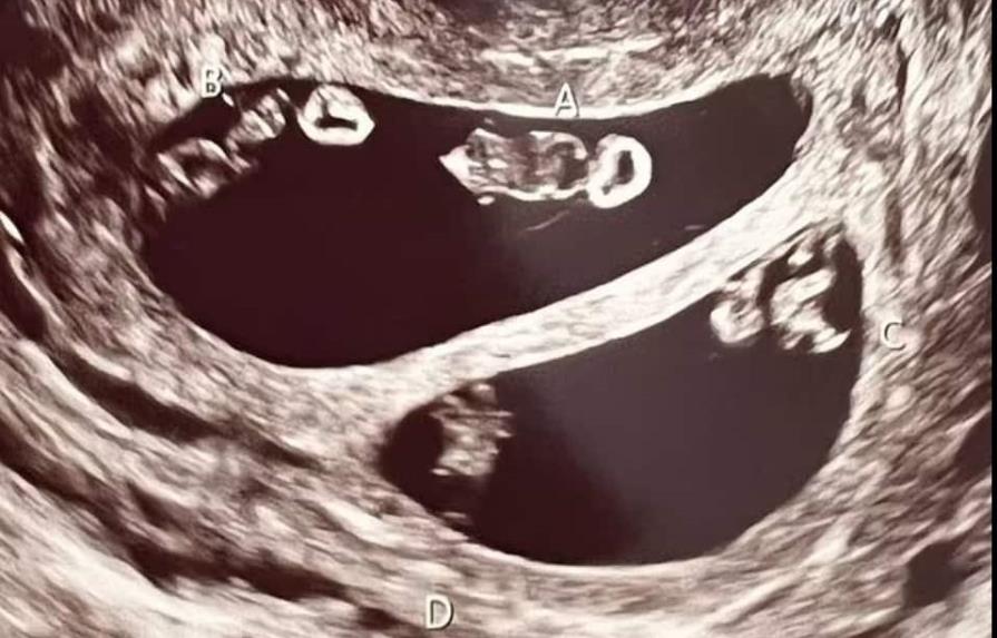 Mujer sorprende a médicos en EEUUU tras salir embarazada de dos pares de gemelos