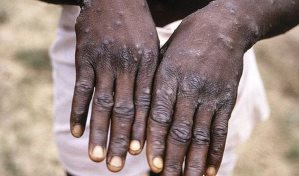 La viruela del simio no es una emergencia mundial por ahora