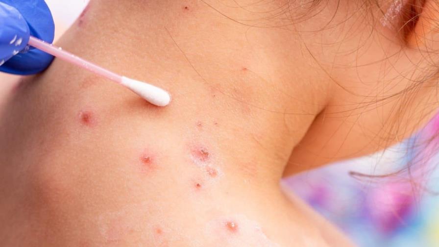 Brasil ya tiene 76 casos confirmados de la viruela del mono