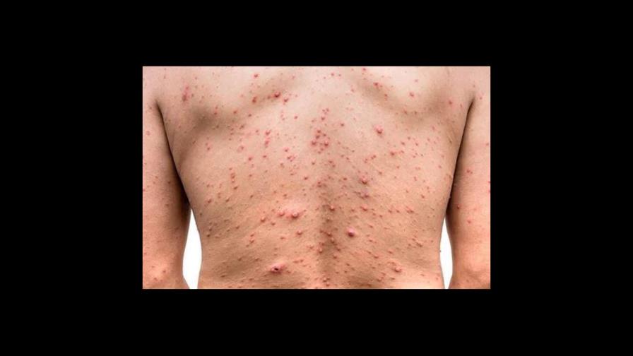 ¿Cómo se contagia y cuáles son los síntomas de la viruela símica?