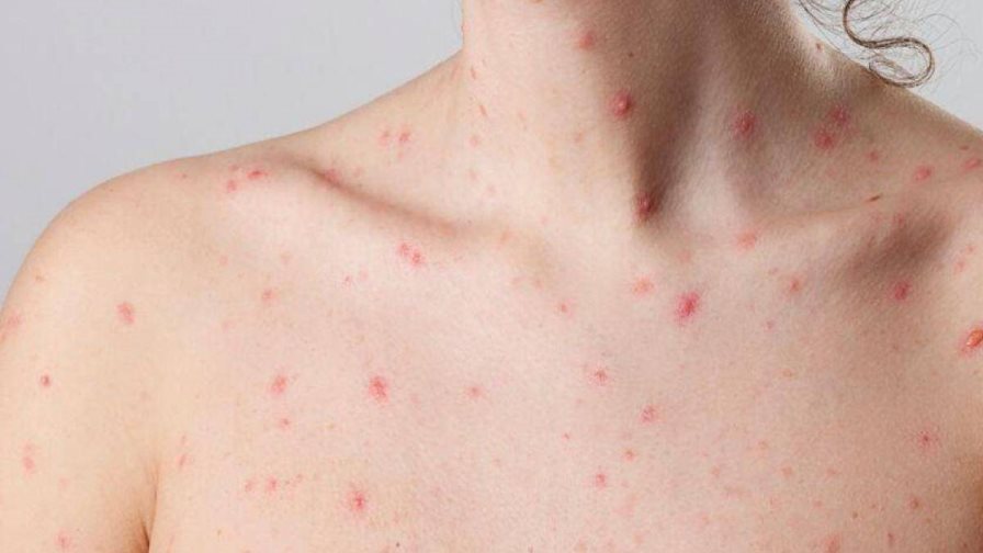 Perú supera los 300 casos de la viruela del mono Perú supera los 300 casos de la viruela del mono