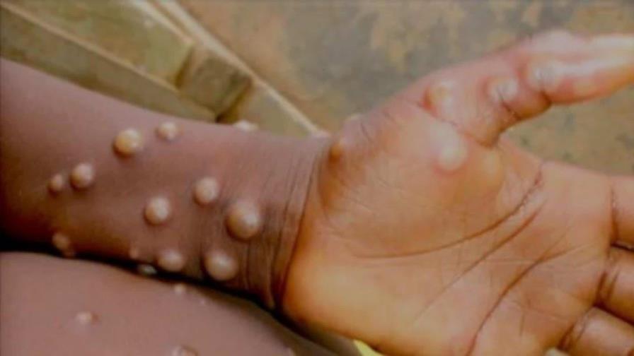 EE.UU. inicia pruebas para detección de viruela del mono