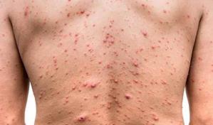 Argentina confirma tres nuevos casos de viruela símica