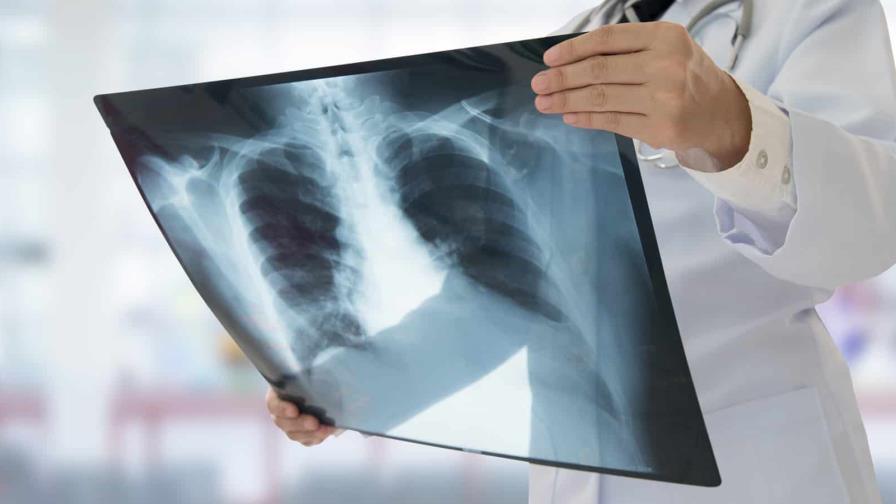 Casi 50 trabajadores sanitarios de Venezuela se infectaron de tuberculosis Casi 50 trabajadores sanitarios de Venezuela se infectaron de tuberculosis