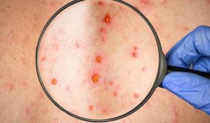 Martinica confirma su primer caso de viruela de mono