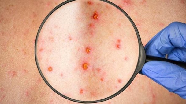 España es el país con más casos de la viruela del mono