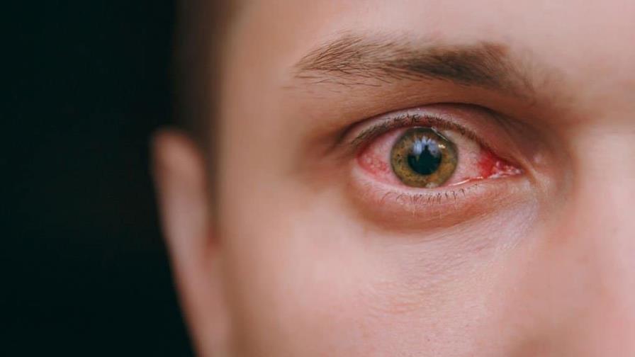 Honduras registra 41 casos de la infección conocida como hongo negro