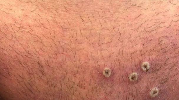 Salud Pública notifica otros dos casos de viruela del mono en el país