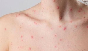 Tailandia detecta su primer caso comunitario de viruela del mono