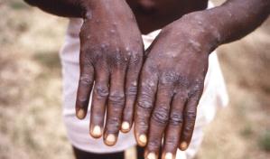 Viruela símica podría ser declarada una emergencia mundial
