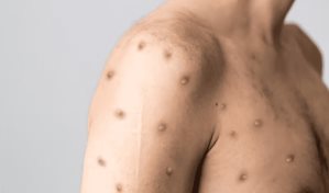 Los casos de viruela símica aumentan a 13 en Puerto Rico