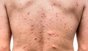 EEUU cree posible frenar  frenar brote de viruela símica