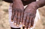 África no ha recibido todavía ninguna vacuna contra la viruela del mono África no ha recibido todavía ninguna vacuna contra la viruela del mono
