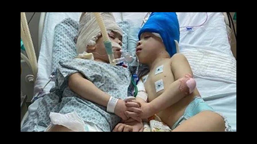 Siameses brasileños unidos por el cráneo fueron separados con ayuda de realidad virtual