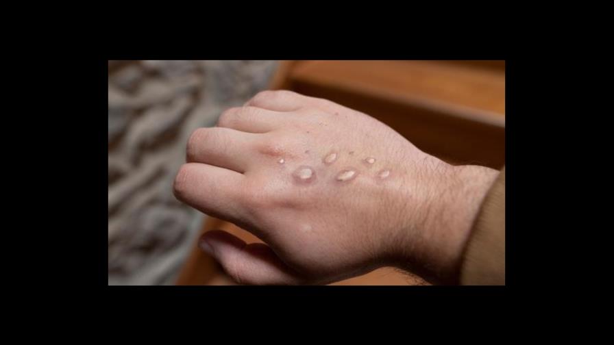 Perú registra primera muerte de una persona infectada con viruela del mono Perú registra primera muerte de una persona infectada con viruela del mono