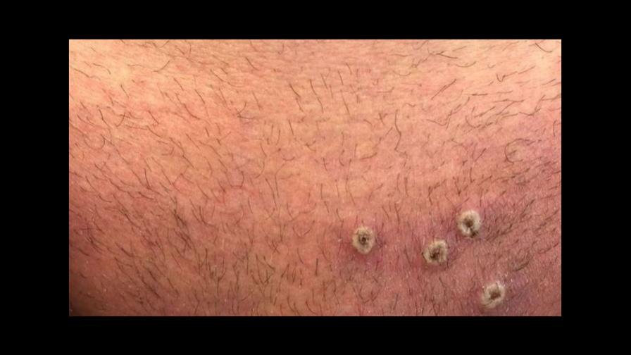 California declara estado de emergencia por viruela símica