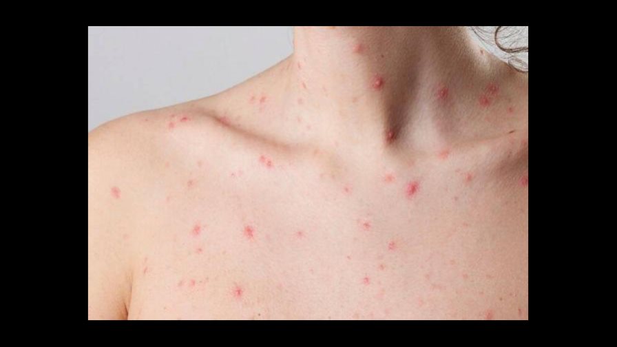 Bolivia confirma el cuarto caso de viruela símica en el este del país